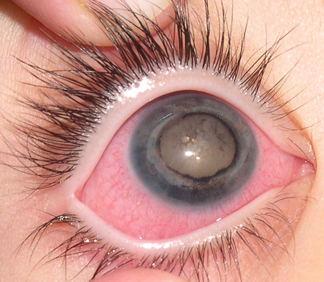International Glaucome Association - Sight Warnings