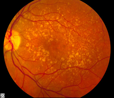 Research Indicates Avastin As Cheaper Alternative For AMD Treatment