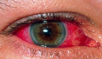 uveitis symptoms