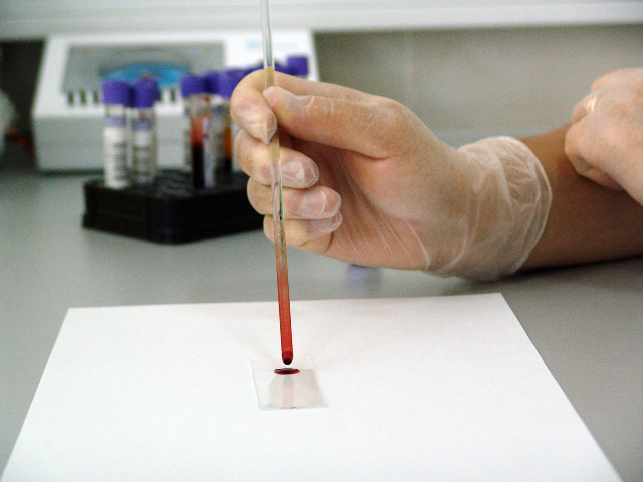 opticians diagnosing diabetes
