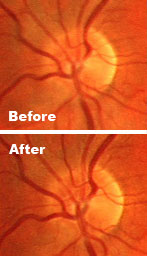 Increased definition in veins post Vitamin C boost