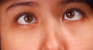 young boy suffers becomes cross eyed viewing 3d film