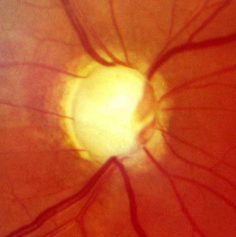 Implant To Measure Pressure And Help Treat Glaucoma