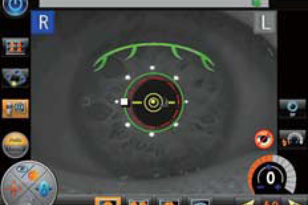 3D Auto Tracking - Nidek AFC 330 Fundus Camera
