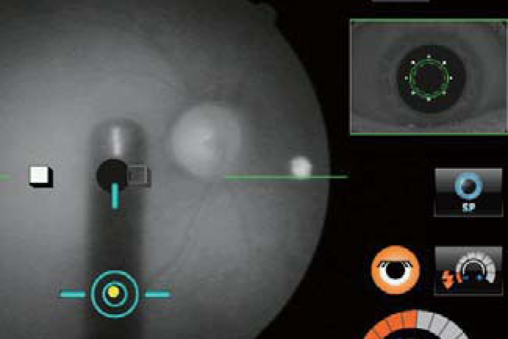 Anterior Eye Monitor - Nidek AFC 330 Fundus Camera