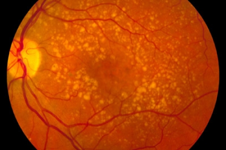 Research Indicates Avastin As Cheaper Alternative For AMD Treatment