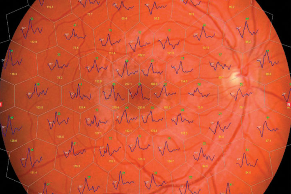 Retimax Overlap Tool CSO Cobra HD