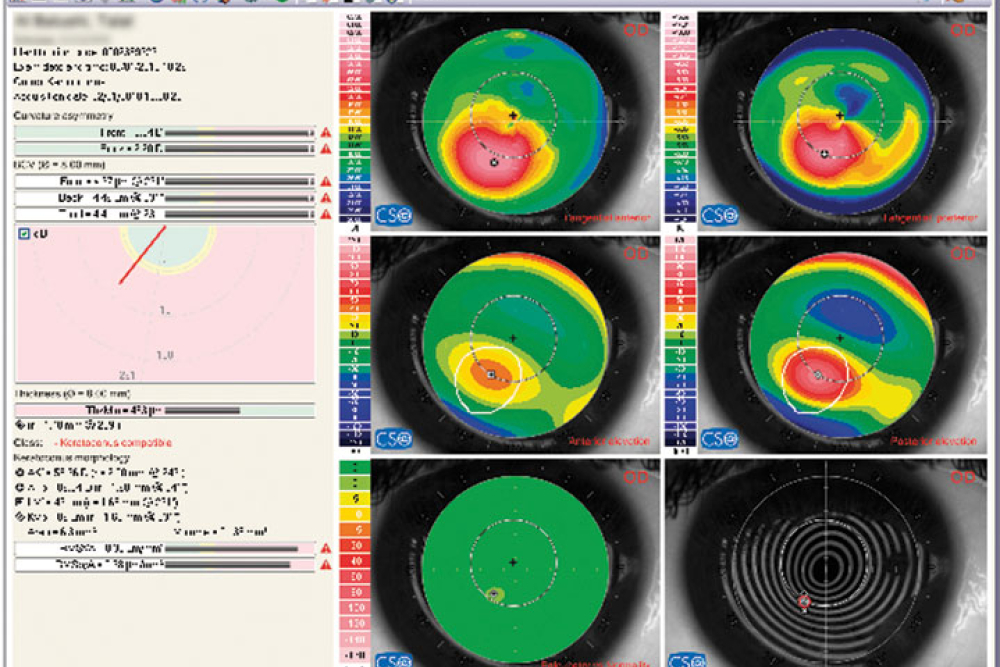 Keratoconus summary - CSO Sirius Topographer
