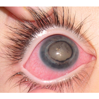 International Glaucome Association - Sight Warnings