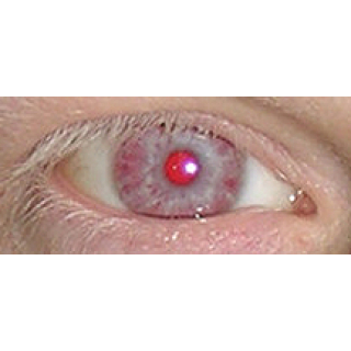 albino eye
